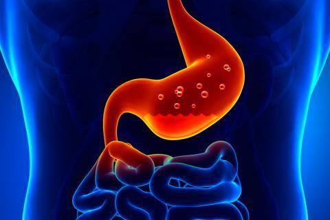 La Gastritis: excelentes nuevos remedios
