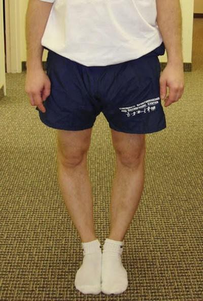 Piernas arqueadas: ¿cómo enderezar las piernas?