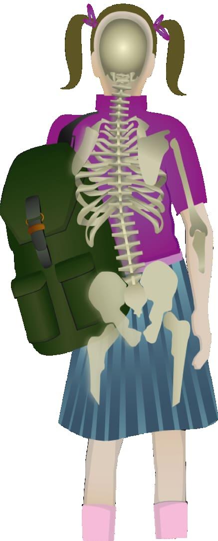 escoliosis idiopática