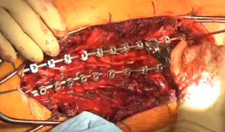 cirugía y escoliosis