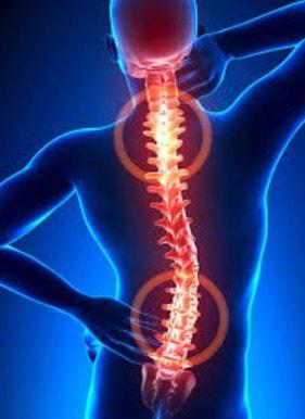 prevenir la escoliosis