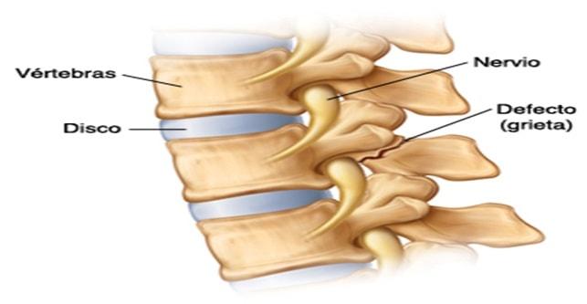 Los factores de riesgo de la espondilolistesis son los deportes que generan demasiada tensión en los huesos de la zona lumbar