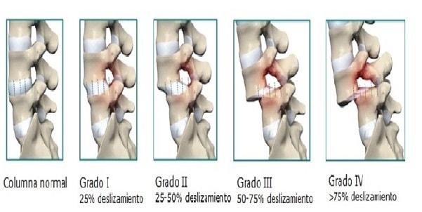 La espondilolistesis se puede clasificar según el deslizamiento.