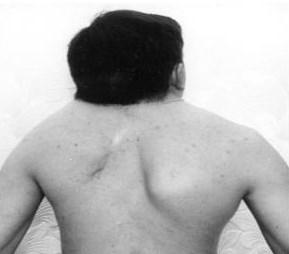 el síndrome Klippel Feil se caracteriza por la fusión congénita de dos o más vértebras cervicales