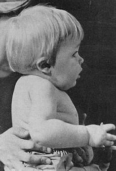 Causas del síndrome de Klippel Feil