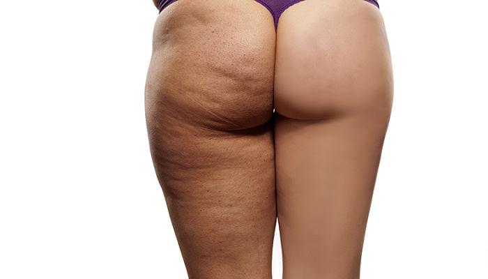 remedio casero para la celulitis