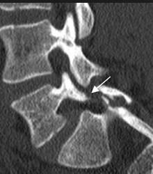 la espondilolisis sintomática implica una queja de dolor lumbar 