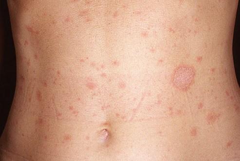 Manchas en la piel: ¿Causadas por estrés?