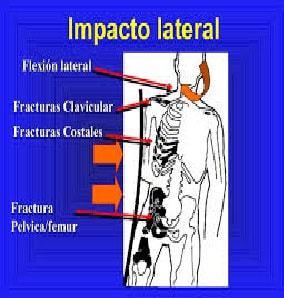 Signos presentes en la escoliosis estructurada