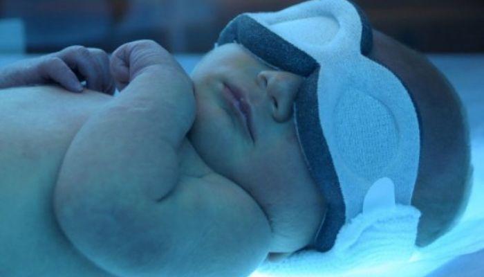 ictericia en el recien nacido