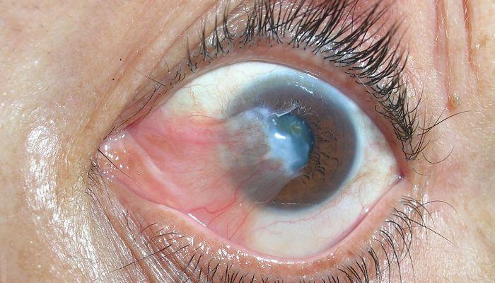 Remedios caseros para la carnosidad en el ojo