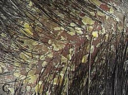 Combatir la Caspa es posible