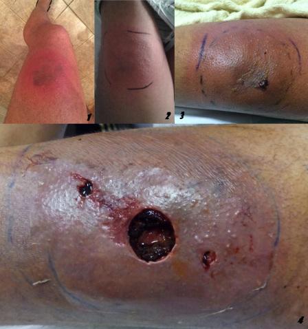 picaduras de araña 501