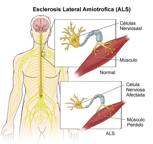 Esclerosis lateral Amiotrofica