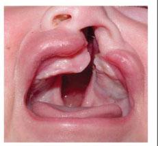 fisura palatina y labio leporino