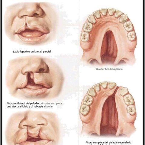 malformacion boca bebe