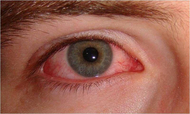Causas de los ojos rojos