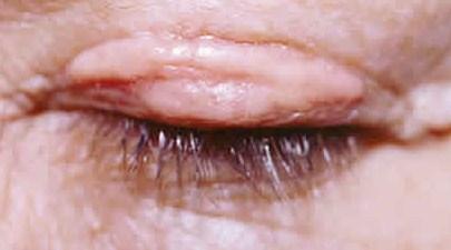 las cicatrices después de una blefaroplastia son producto de errores durante la cirugía 