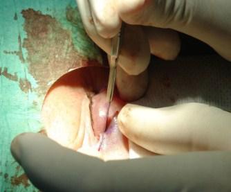 La blefaroplastia extendida no es un procedimiento muy usado por los especialistas