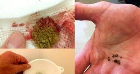 Infusiones para tratar los cálculos renales