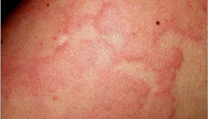 alergia o urticaria