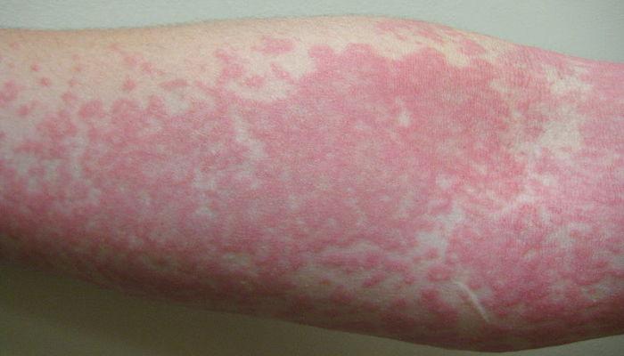 tratamientos para la urticaria