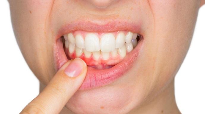 clinica-dental-aviles-centro-dental-innova-endodoncia-inflamacion-encias
