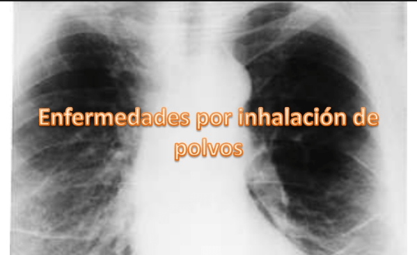 enfermedades ocasionadas por polvos