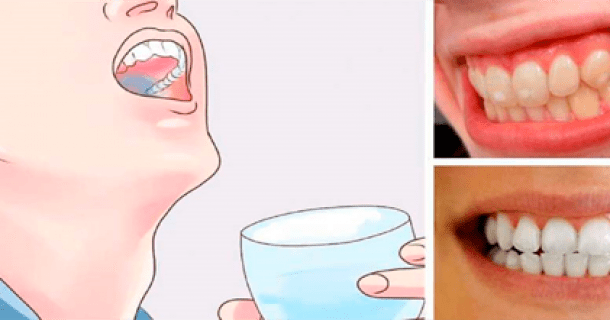 Remedios caseros para el sarro