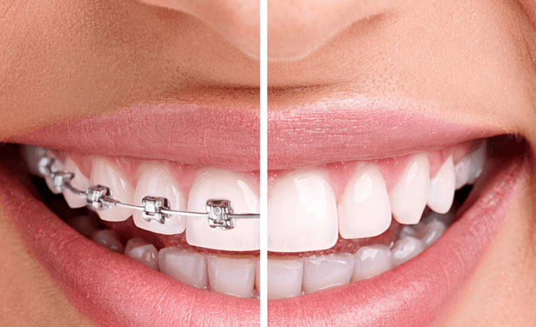 Invisalign brackets