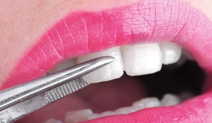 centro-dental-innova-clinica-dental-aviles-cuando-poner-carillas-dentales.