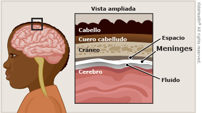 Meningitis infografía herbotop
