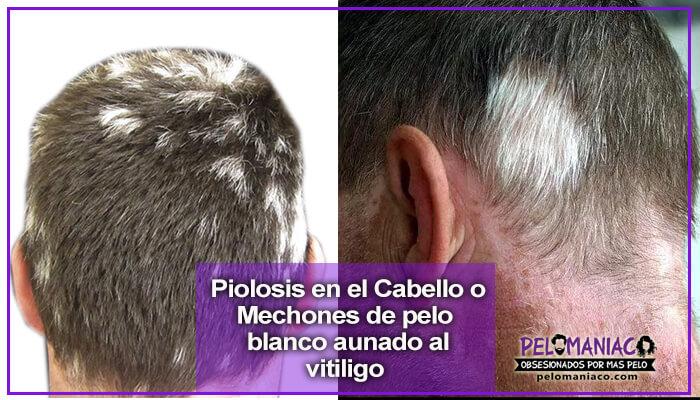 poliosis en el cabello y el vitiligo