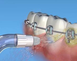 irrigador dental para ortodoncia