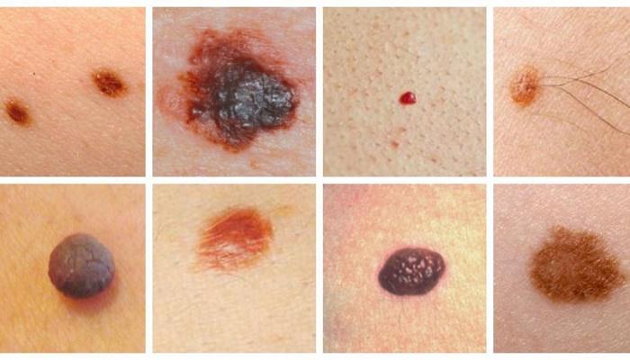 Melanomas en la piel