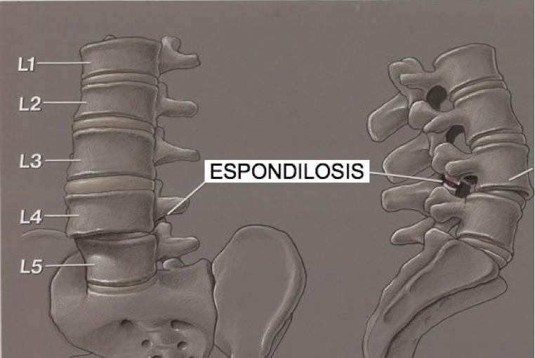 Espondilosis (osteoartritis espinal)