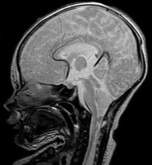Malformación de Chiari