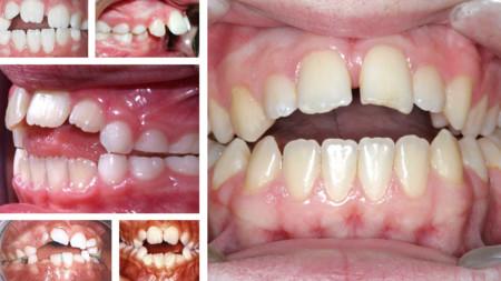 mordiada abierta por succión del dedo pulgar