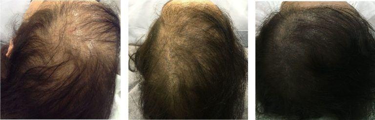 Micropigmentación Capilar, todo lo que debes saber 