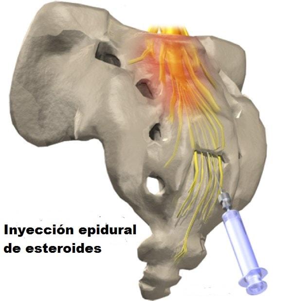 En el tratamiento para fibrosis epidural se pueden considerar las inyecciones de esteroides