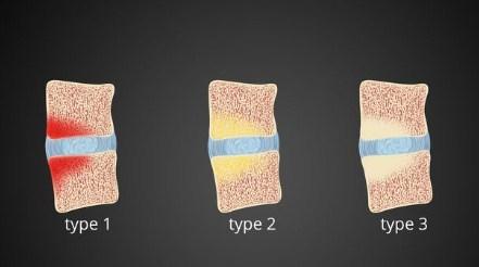 Existen 3 tipos de signos modic