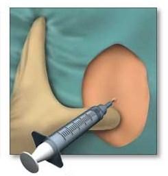 El médico puede recomendar inyecciones para reducir la coxidinia