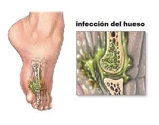 Los pacientes con diabetes son más propensas a contraer osteomielitis