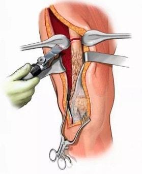 cirugía por osteomielitis 