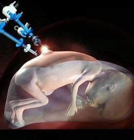 se han desarrollado terapias integradas de células madre para la espina bífida