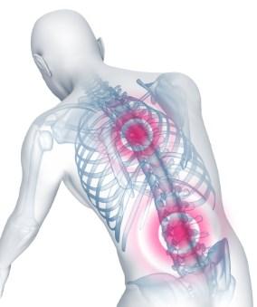 La terapia con células madres detiene la deformación que provoca la espondilitis anquilosante