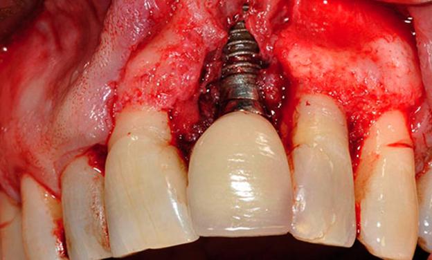 enfermedad periimplantaria