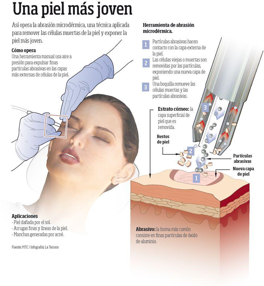 Resultado de imagen de peeling infografÃ§ia