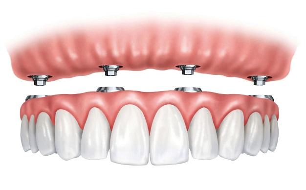 protesis-dental-sobre-implantes-clinica-dental-aviles-centro-dental-innova