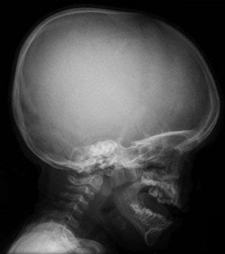 Cabeza grande con frente convexa